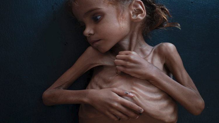 المجاعة-تفتك-باطفال-اليمن